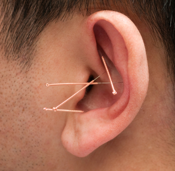 ear acupuncture